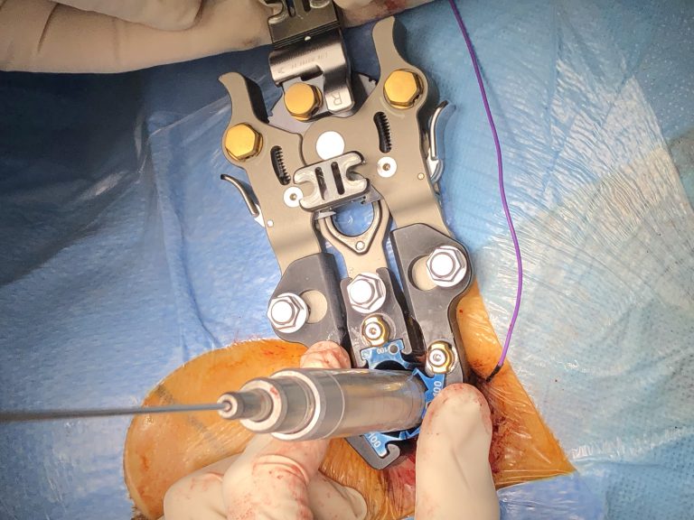 Tres intervencions de columna amb la tècnica lateral lumbar XLIF